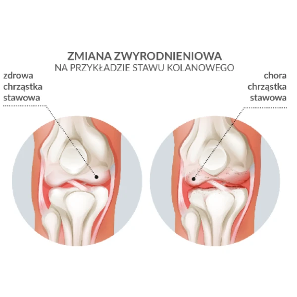 ARTOSYAL 80 2% SÓL SODOWA KWASU HIALURONOWEGO DO INIEKCJI DOSTAWOWYCH